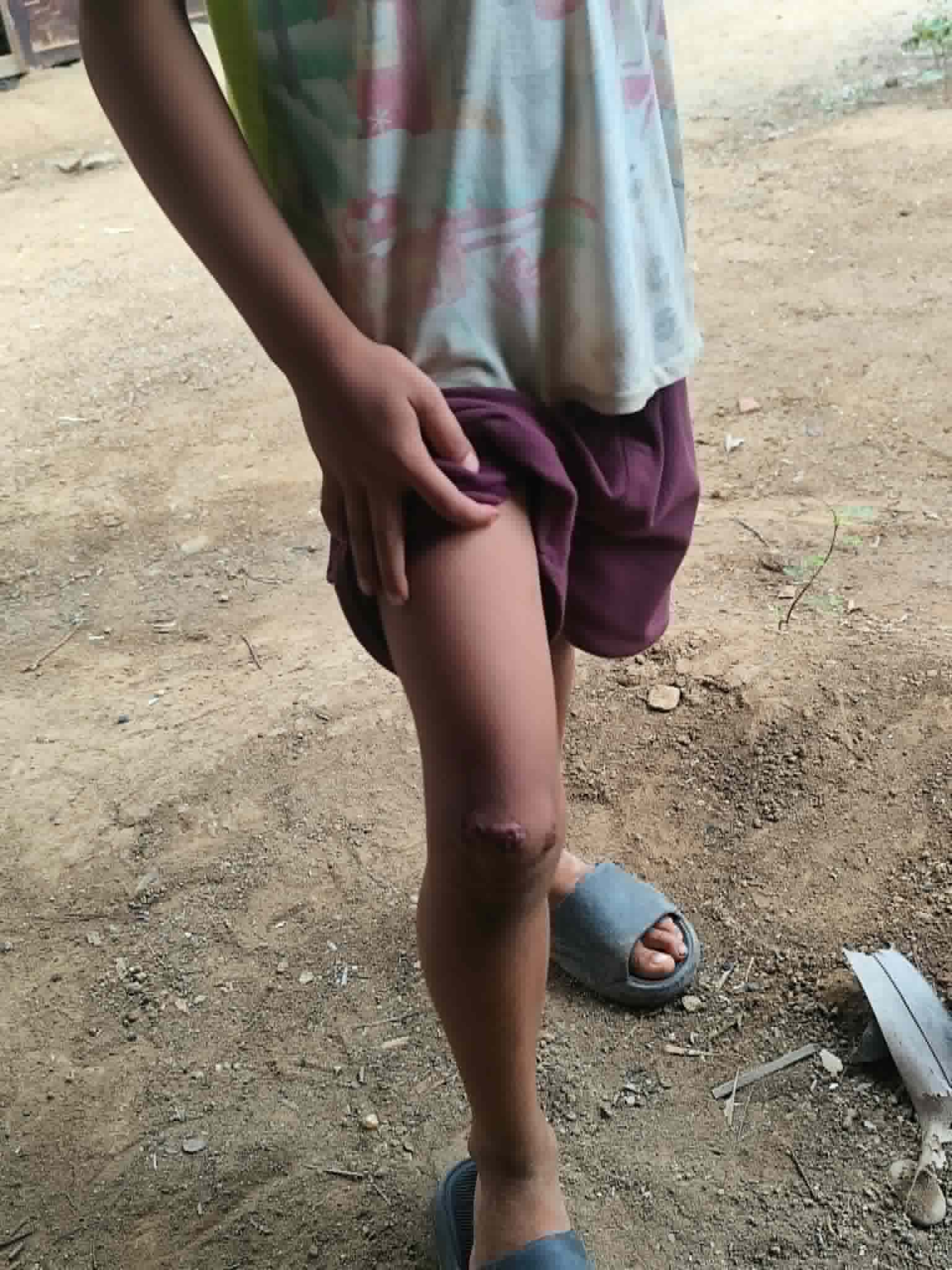 ပုလဲမြို့နယ်ထဲက ကျေးရွာတချို့မှာ အရေပြားရောဂါဖြစ်ပွားနေပြီး ဆေးဝါးအကူအညီလိုအပ်နေ